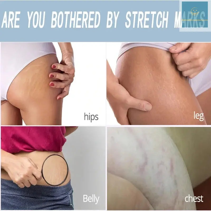 7 Days Stretch Marks cream For Pregnancy Remove Postpartum Obesity Women Scar Without Side Effect Butt Firm Lift Skin Body Cream lifelikesiliconereborns.com