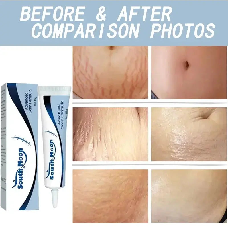 7 Days Stretch Marks cream For Pregnancy Remove Postpartum Obesity Women Scar Without Side Effect Butt Firm Lift Skin Body Cream lifelikesiliconereborns.com